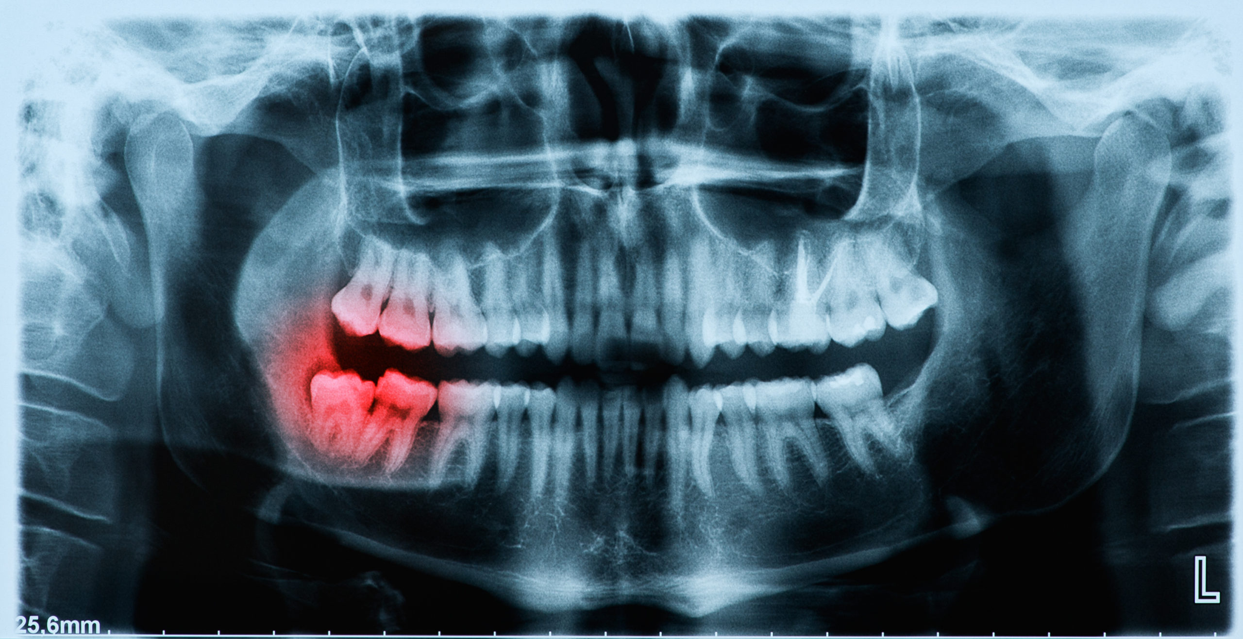 Panoramic x-ray image of teeth